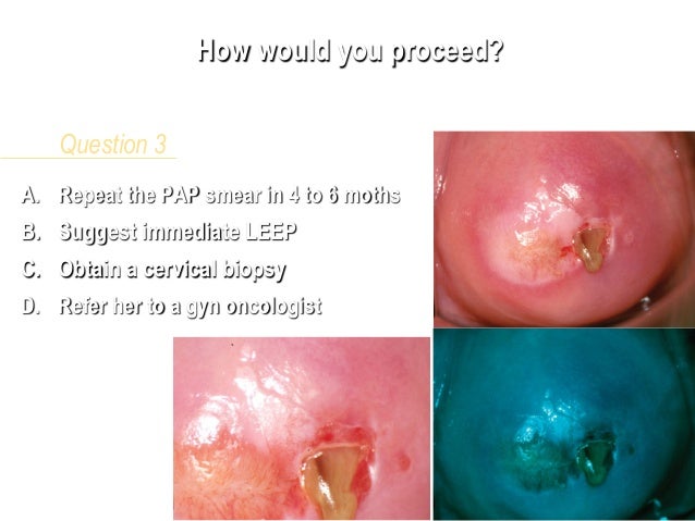 Cervical cancer ayurvedic remedy uterine most cancers from hpv