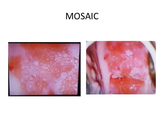 Mosaic Pattern In Colposcopy | colposcopy2 1 Mosaic Pattern In Colposcopy | colposcopy2 1