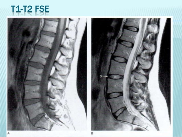 El dolor en los riñones en la hernia intervertebral