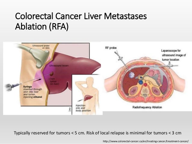 Chicago Illinois Colon Liver Cancer Specialist