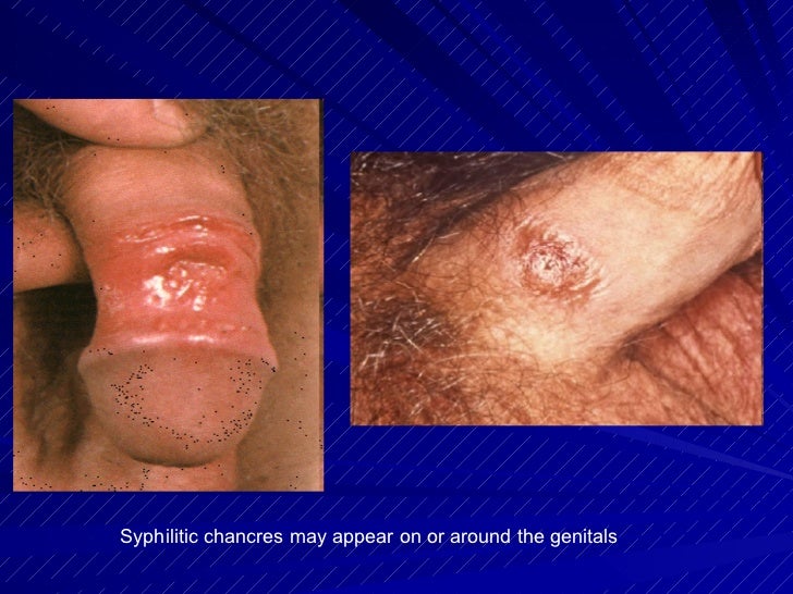 syphilis chancre #10