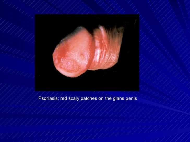 Skin Problems On Penis 13