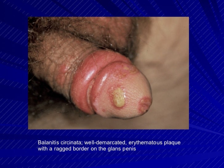 Penis or Groin Rash | STD Symptoms in Men - STDcheck.com