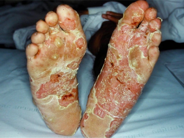 common skin diseases herald patch christmas tree