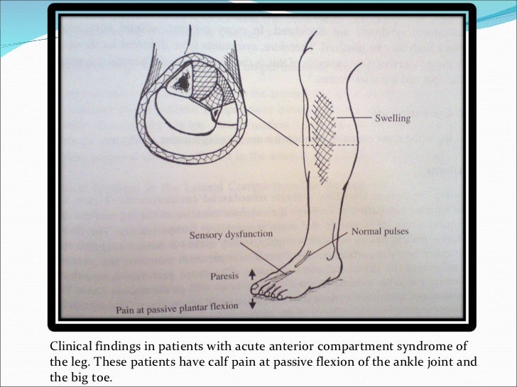 Compartment syndrome
