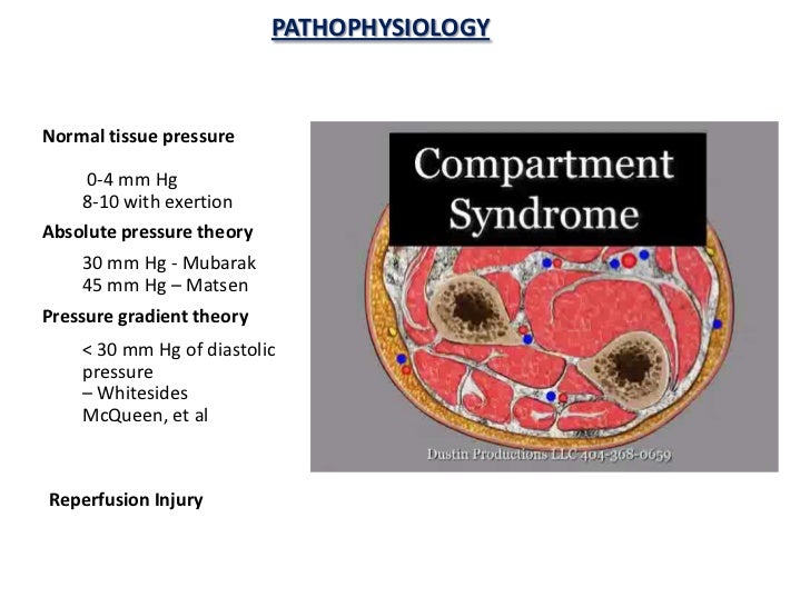 Compartment syndrome