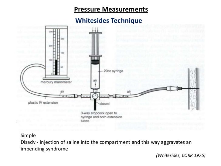 Compartment syndrome