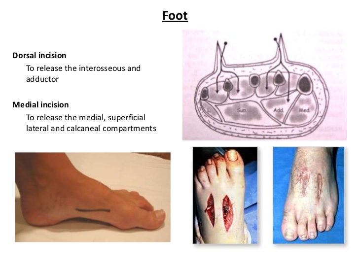 Compartment syndrome