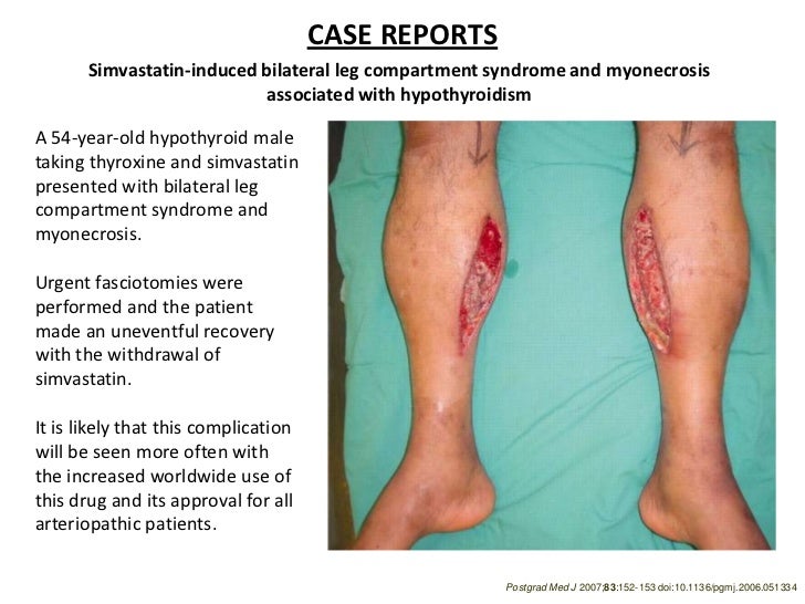 symptoms of compartment syndrome in lower leg
