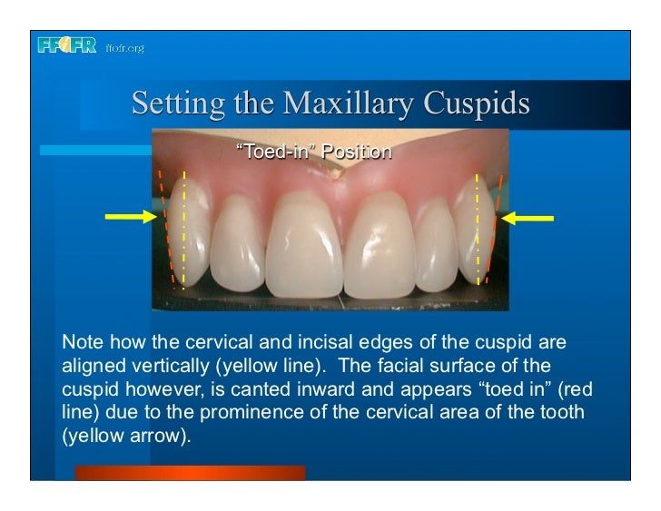 Complete dentures 16.occlusal schemes lingualized occlusion