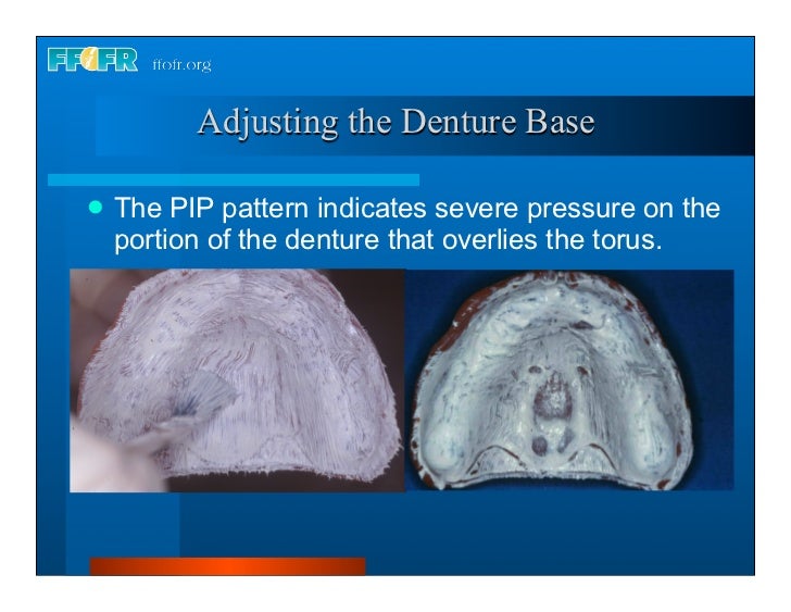 Complete dentures 30. insertion and followup