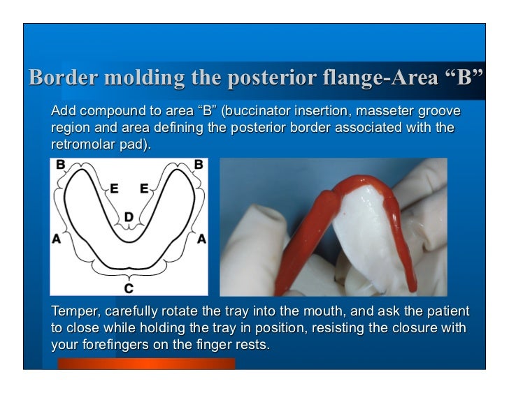 Complete dentures 7. final impressions
