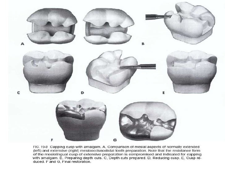 Complex amalgam restoration