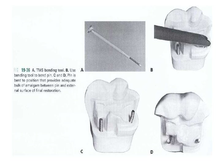 Complex amalgam restoration
