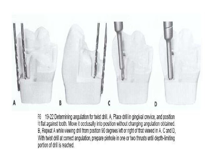Complex amalgam restoration