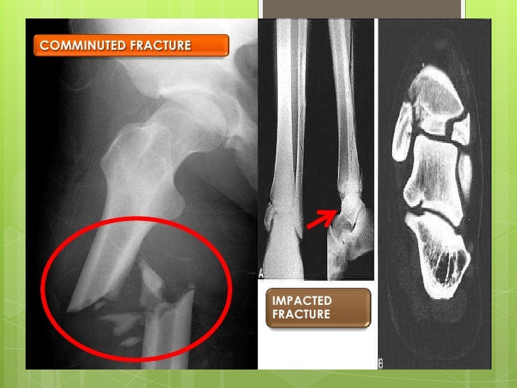 comminuted fracture common location comminuted fracture common location