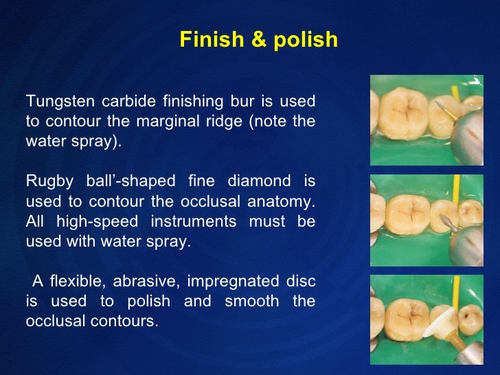 Composite resin technique
