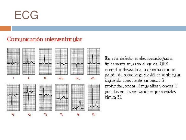 Comunicación interventricular