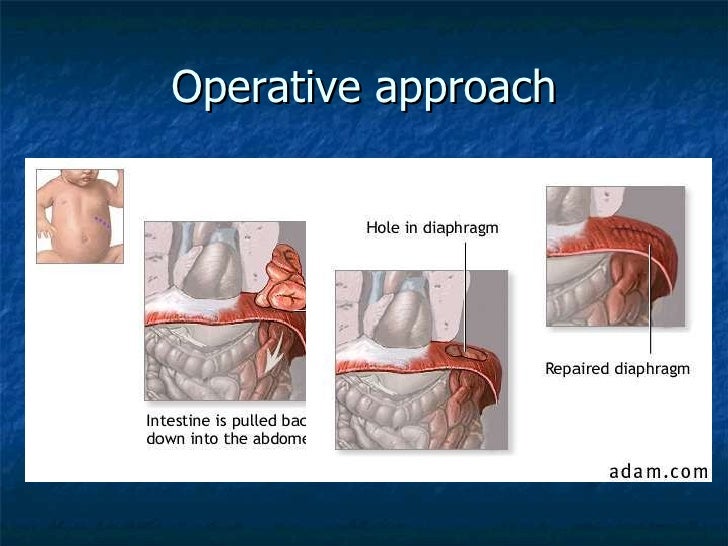 Congenital Diaphragmatic Hernia