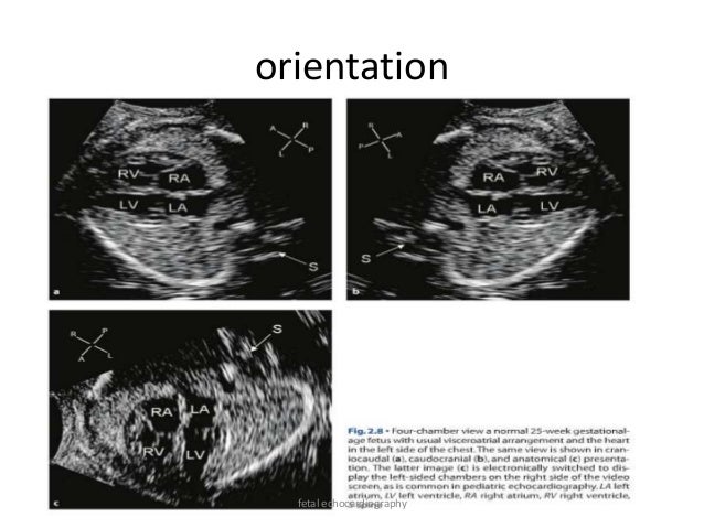 Fetal Echocardiography