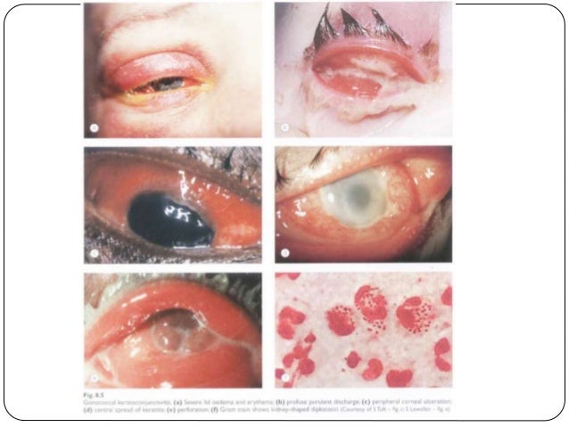 Staph infection treatment ciprofloxacin eye Staph infection treatment ciprofloxacin eye