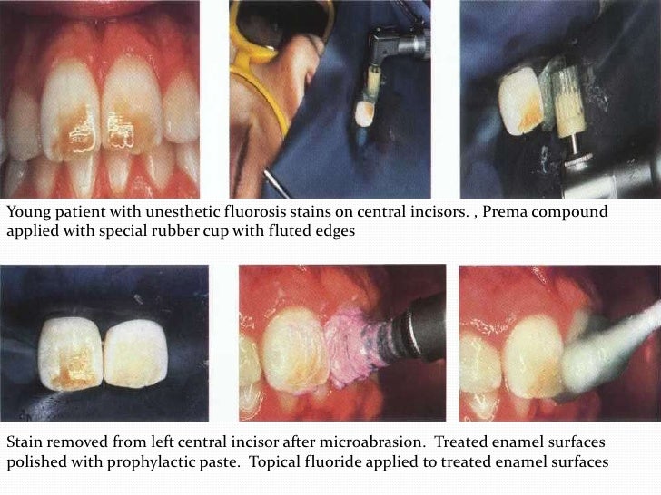 Conservative esthetic procedures
