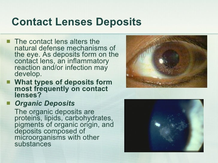 Contact Lenses