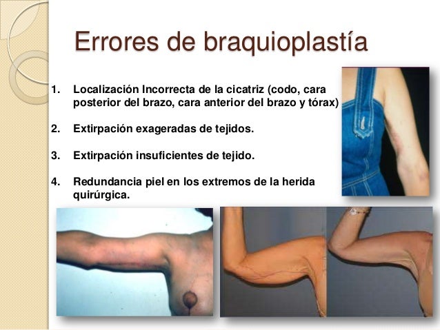 Ejercicio Para Rellenar Hueco Lateral Del Glúteo