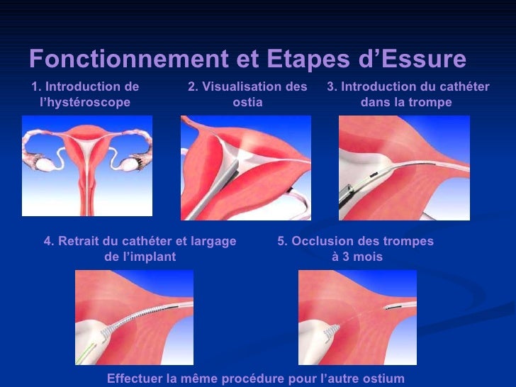 Contraception Et Stérilisation Tubaire Pp 09 02 10