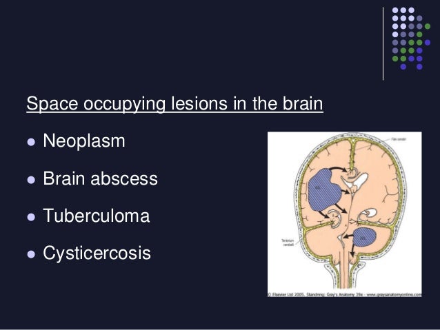 brain swelling in pediatric cerebral malaria Malaria, cerebral clinical trials treating brain swelling in pediatric cerebral malaria enteral levetiracetam for seizure control in pediatric cerebral malaria. brain swelling in pediatric cerebral malaria Malaria, cerebral clinical trials treating brain swelling in pediatric cerebral malaria enteral levetiracetam for seizure control in pediatric cerebral malaria.