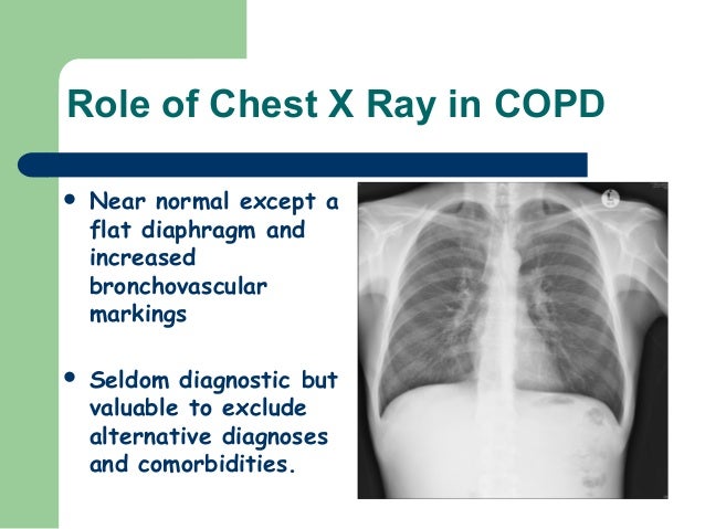 Oxygen Therapy for COPD images pictures Oxygen Therapy for COPD