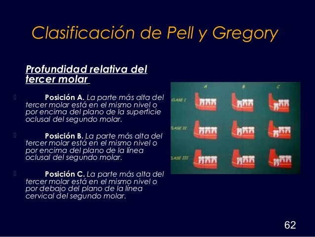 cirugia del cordal retenido
