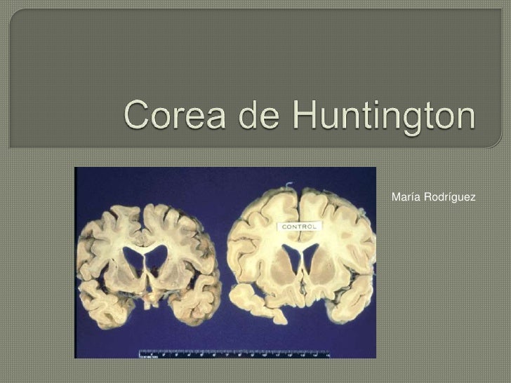 Corea de huntington. Corea de huntington.