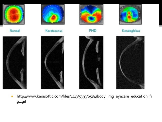 Eye Surgery Lasix Bangkok