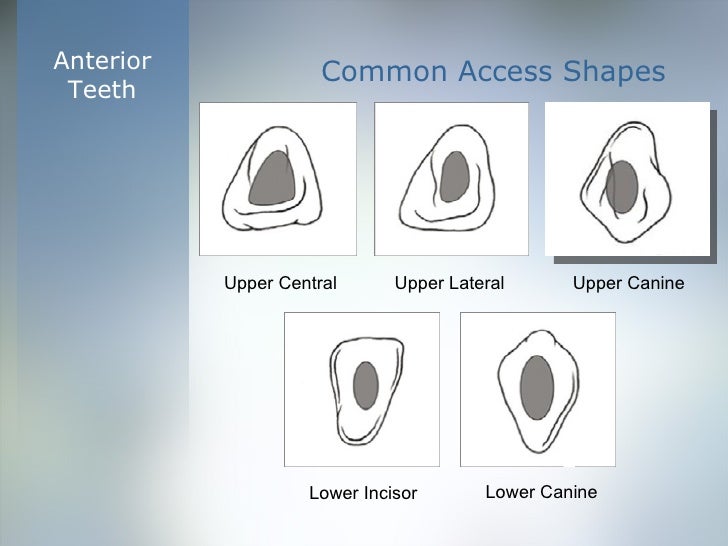 Coronal Cavity Preparation ‘Access’
