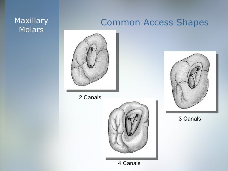 Coronal Cavity Preparation ‘Access’