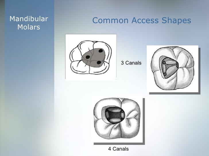 Coronal Cavity Preparation ‘Access’