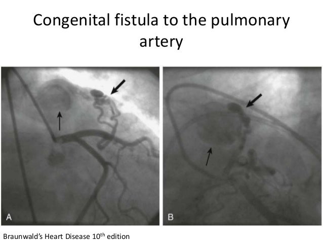 How to Treat an Adult Heart Murmur foto pics How to Treat an Adult Heart Murmur
