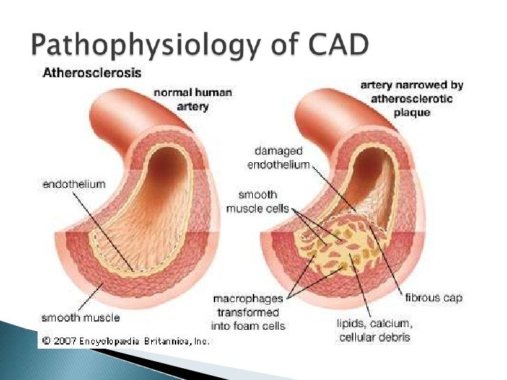 pathophysiology of coronary diseases Pathophysiology of acute coronary syndrome and heart failure classification of acute coronary syndrome acute coronary syndrome (acs) refers to any condition attributed to obstruction of the coronary arteries which reduces blood flow to the heart, and includes unstable angina and myocardial infarction (mi. pathophysiology of coronary diseases Pathophysiology of acute coronary syndrome and heart failure classification of acute coronary syndrome acute coronary syndrome (acs) refers to any condition attributed to obstruction of the coronary arteries which reduces blood flow to the heart, and includes unstable angina and myocardial infarction (mi.