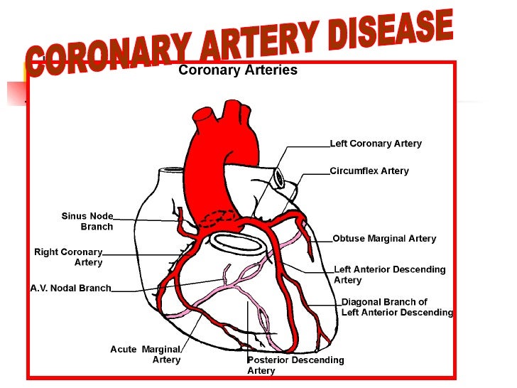 coronary artery disease The blockage of the arteries within the heart, due to plaque build up, causes coronary artery disease, also called coronary heart disease an overview of the coronary. coronary artery disease The blockage of the arteries within the heart, due to plaque build up, causes coronary artery disease, also called coronary heart disease an overview of the coronary.