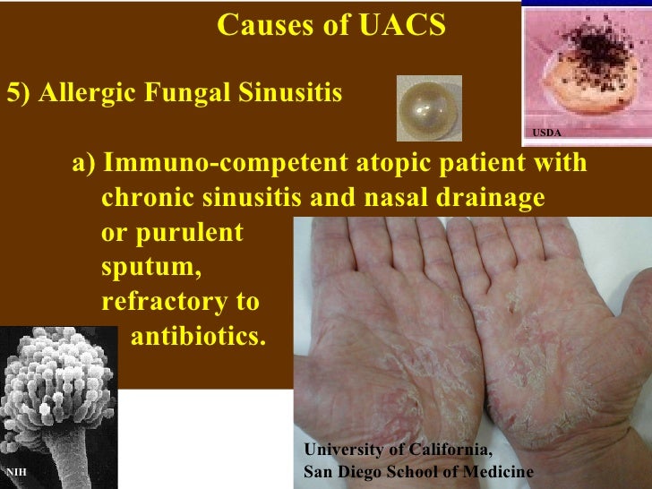 Broken nose sinus contamination treatment for painful sinus infection