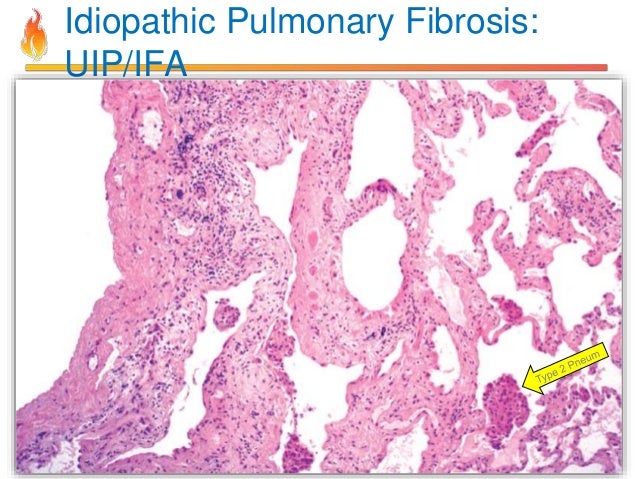 Mesothelioma chemotherapy prognosis asbestos lawyer los angeles