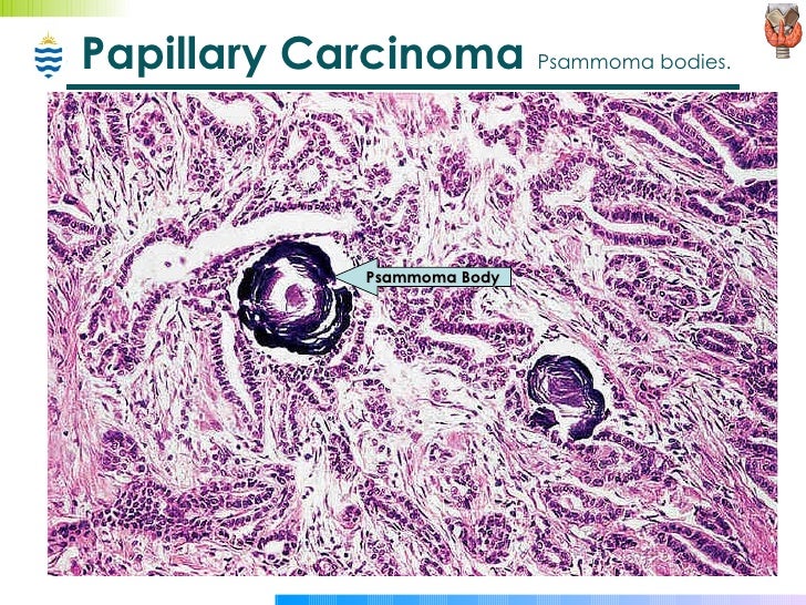 Anaplastic Thyroid Cancer Overview Diagnosis Treatment
