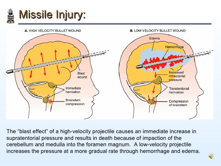 Pathology of Head Injury contusion wound diagram 