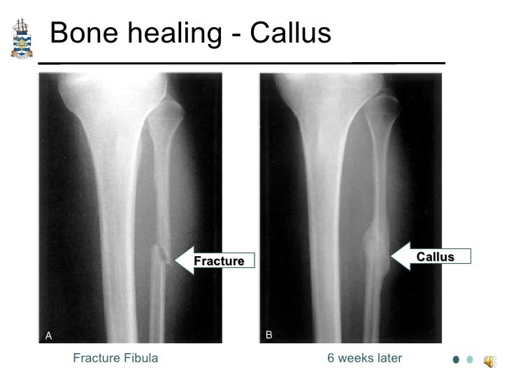 healing process of a bone fracture The natural process of healing a fracture starts when the injured bone and surrounding tissues bleed, forming a fracture hematoma the blood coagulates to form a. healing process of a bone fracture The natural process of healing a fracture starts when the injured bone and surrounding tissues bleed, forming a fracture hematoma the blood coagulates to form a.