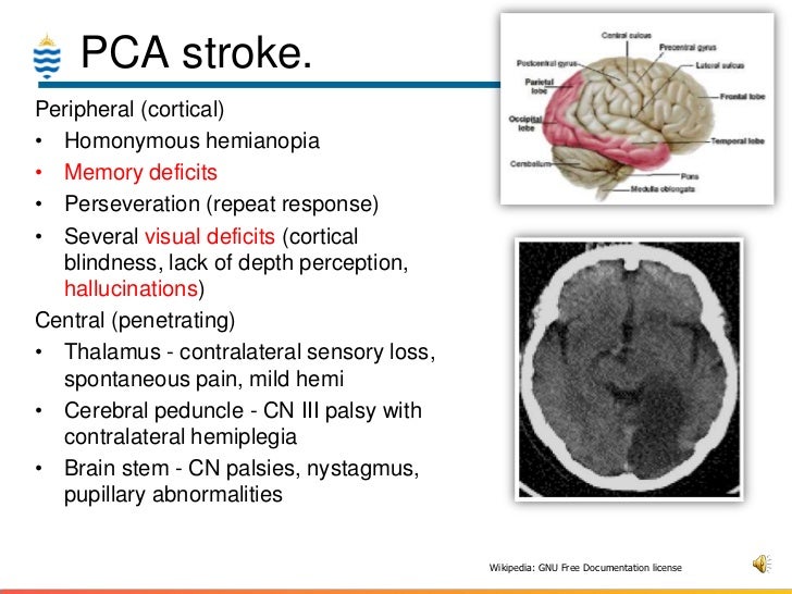 what is the signs and symptoms of a stroke ischemic stroke of the pons