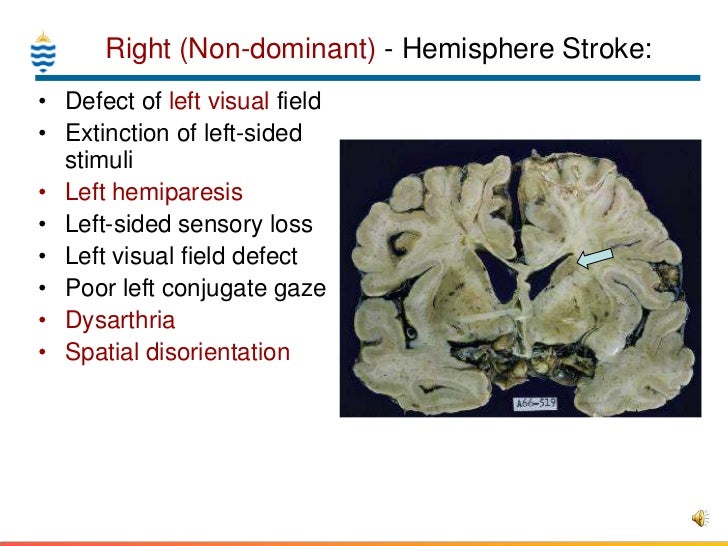 stroke symptoms unexpected memory loss