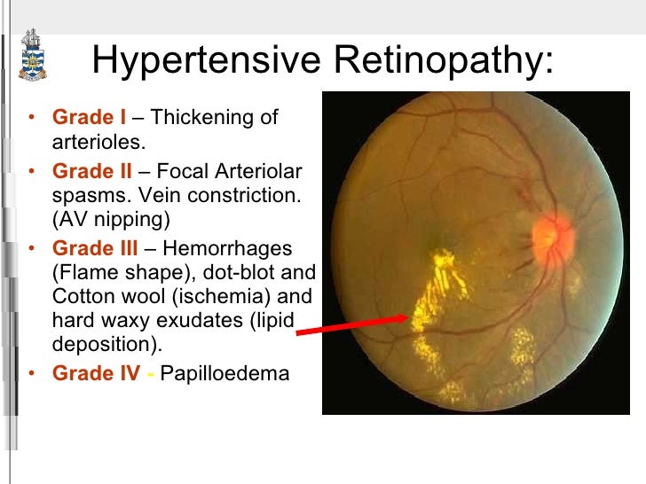 hypertensive retinopathy