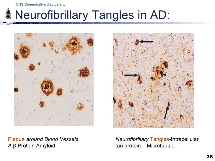 Pathology of CNS degenerations