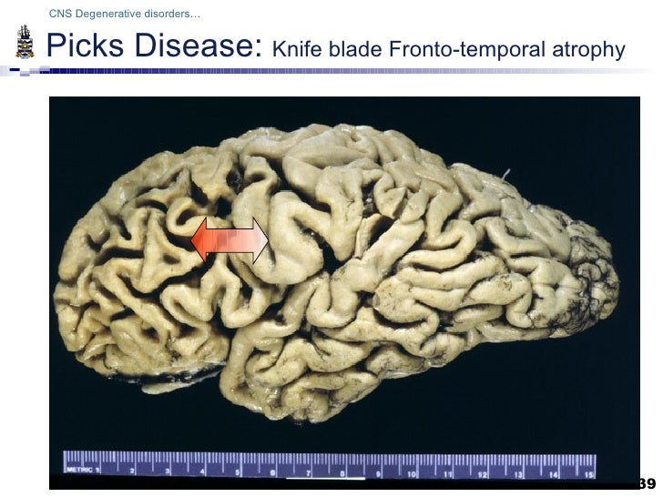 Pathology of CNS degenerations